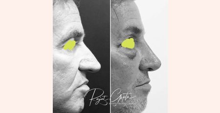 Celebrity Rhinoplasty Surgery