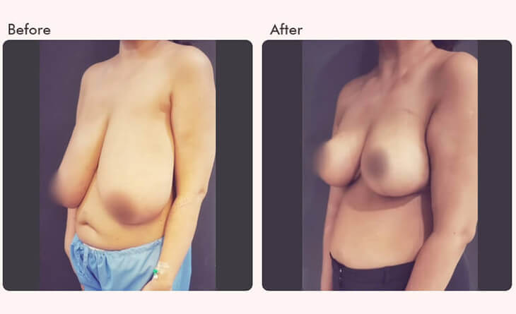 breast reduction surgery before and after