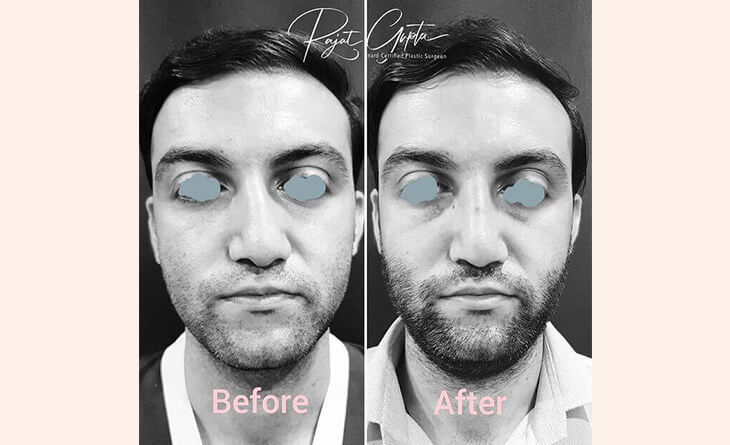 rhinoplasty surgery before and after