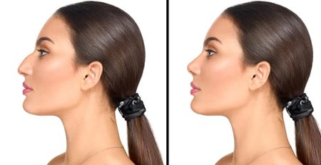 droopy nose causes