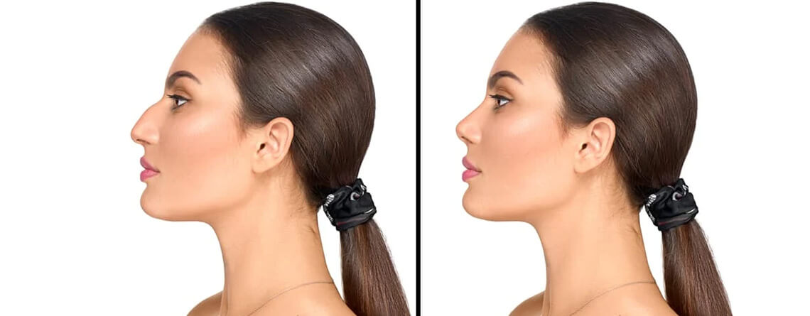 droopy nose causes