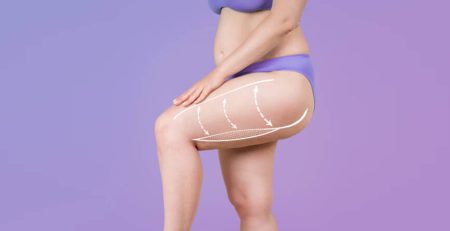 thigh lift surgery