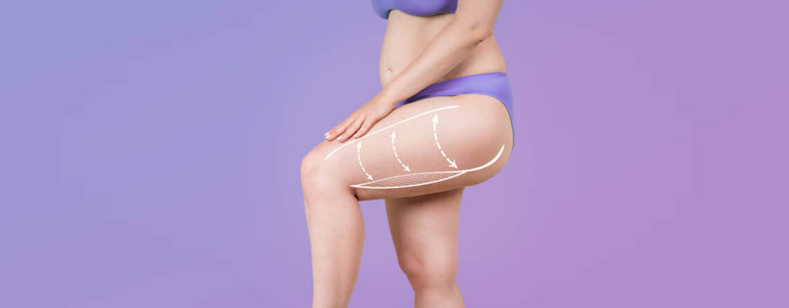 thigh lift surgery