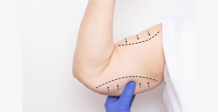 arm lift surgery