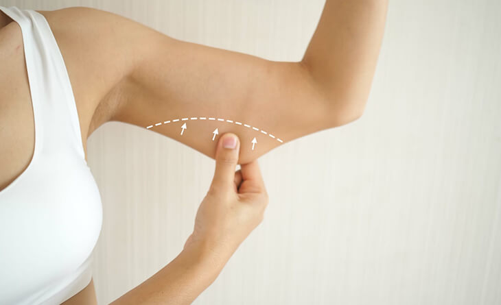 arm lift surgery