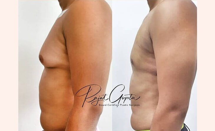 gynecomastia surgery before and after