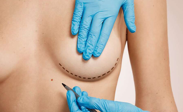 breast reconstruction surgery