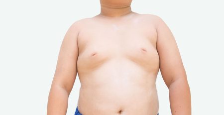 gynecomastia surgery