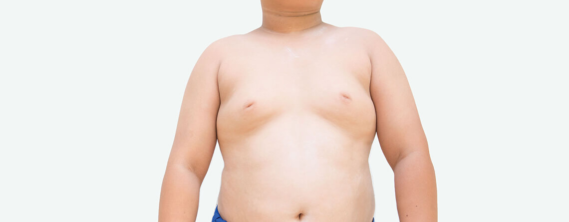 gynecomastia surgery