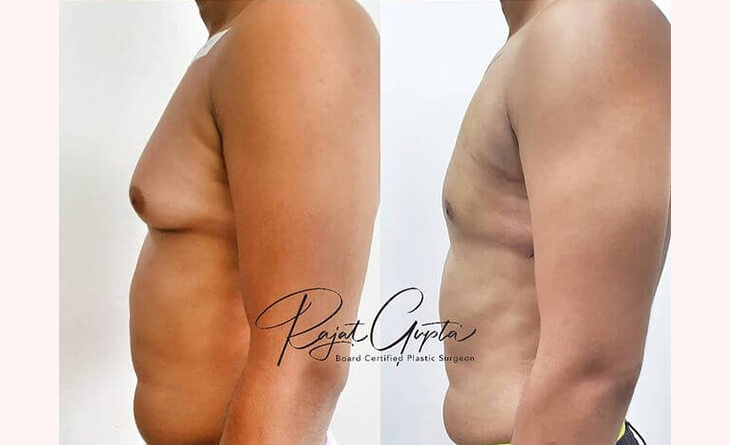 gynecomastia surgery before and after