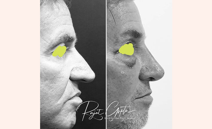 Nose job surgery before and after