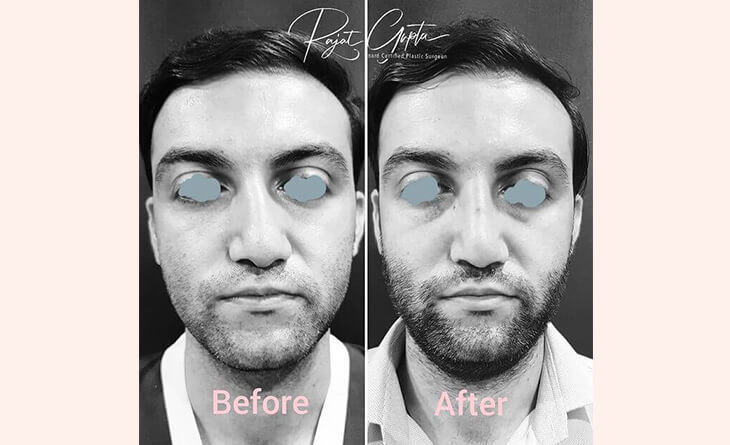 Rhinoplasty Surgery before and after