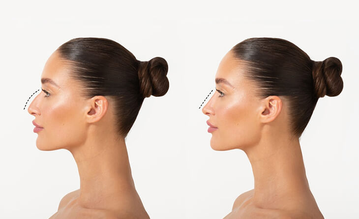 nose reshaping surgery