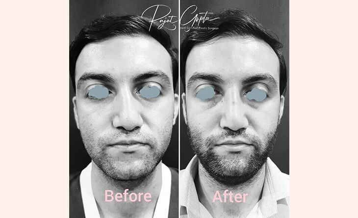 Rhinoplasty surgery before and after