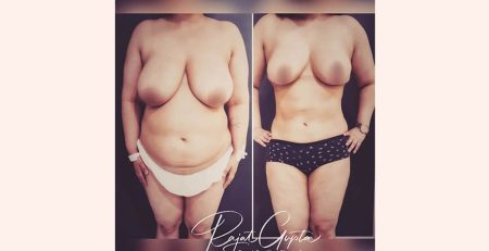liposuction surgery