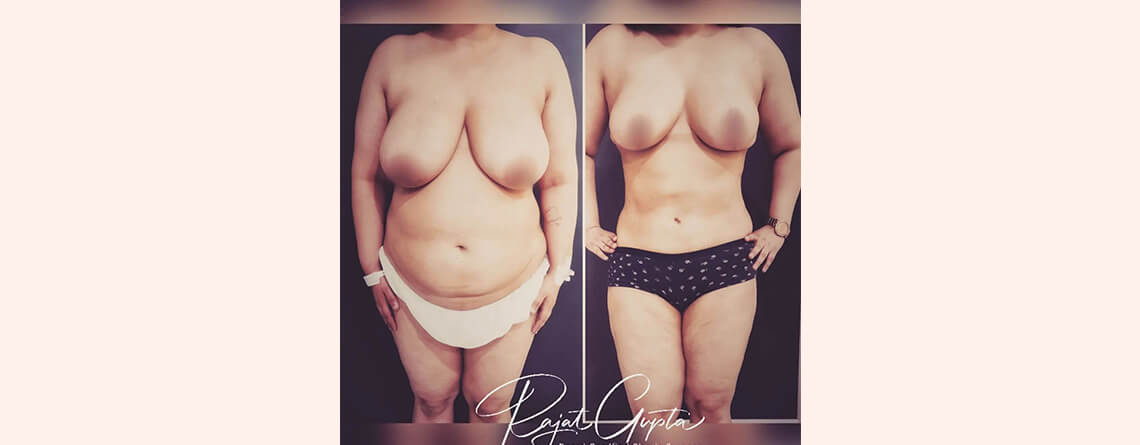 liposuction surgery