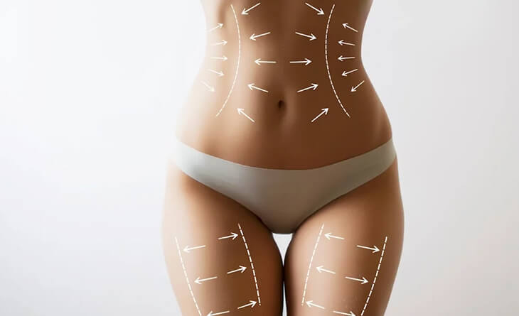 liposuction surgery