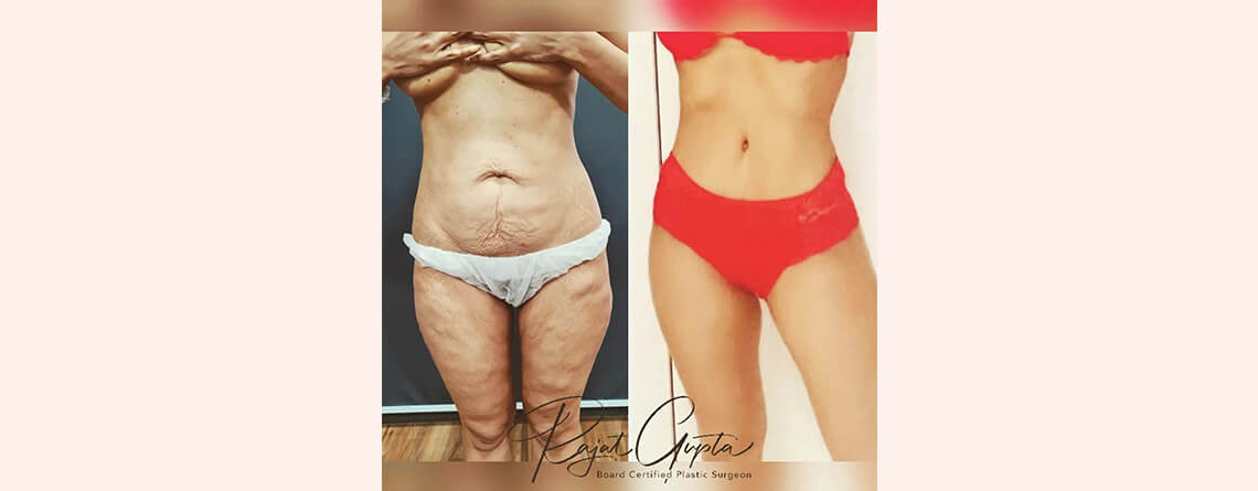 tummy tuck surgery before and after