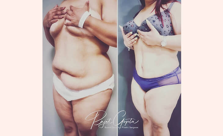 tummy tuck surgery