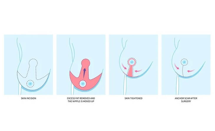 Upper Pole Fullness Breast Reduction