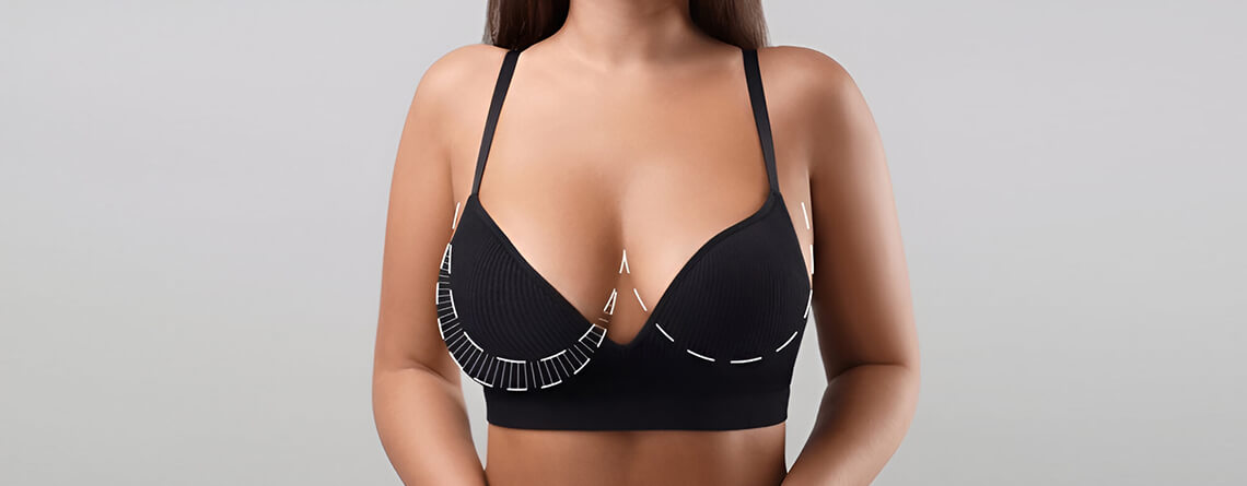 Upper Pole Fullness Breast Reduction