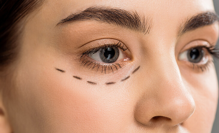 lower blepharoplasty surgery
