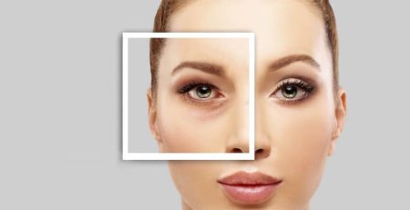 lower blepharoplasty surgery