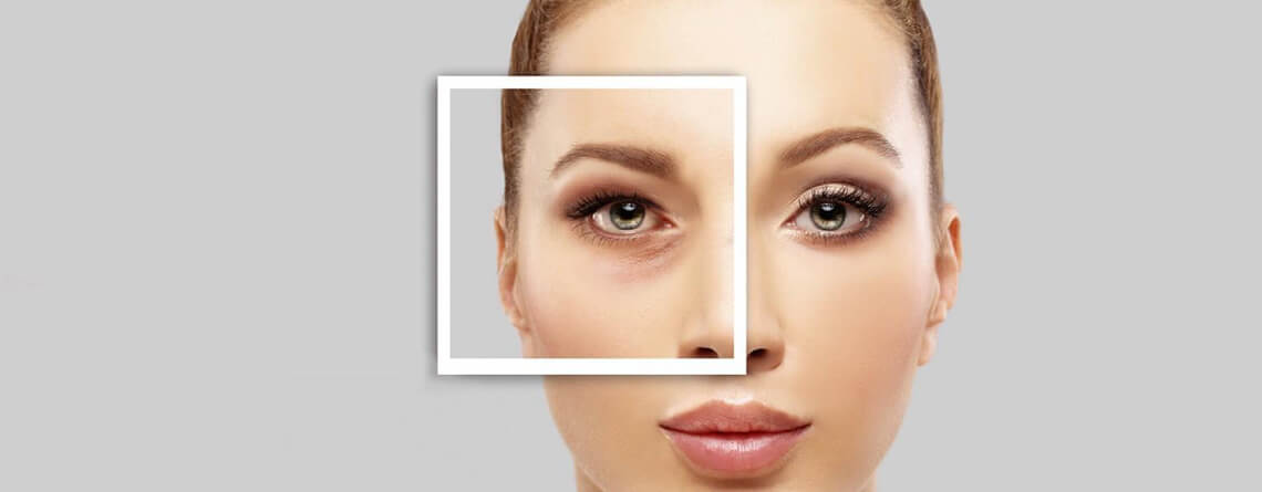 lower blepharoplasty surgery