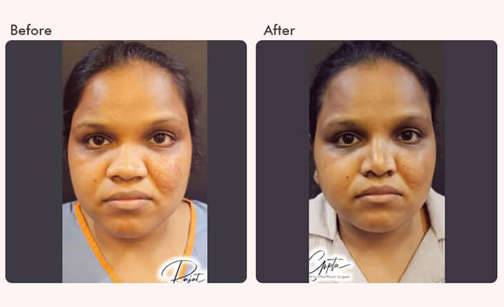 rhinoplasty surgery before and after