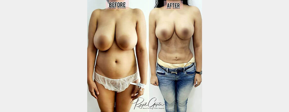 Breast Reduction Surgery before and after