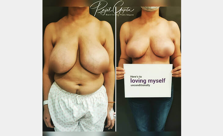 Breast Reduction Surgery