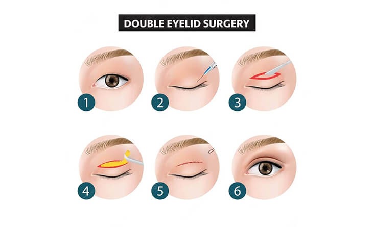 double eyelid surgery