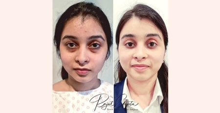 double eyelid surgery