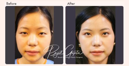 double eyelid surgery