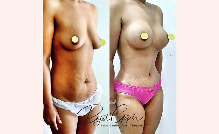 tummy tuck surgery before and after