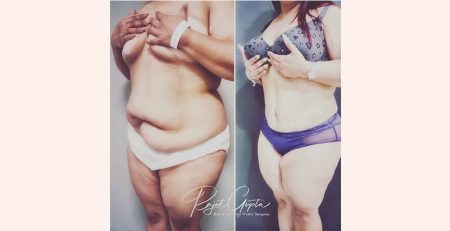 tummy tuck surgery