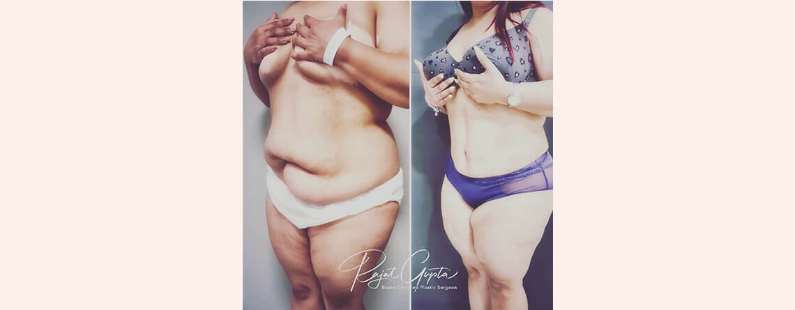 tummy tuck surgery