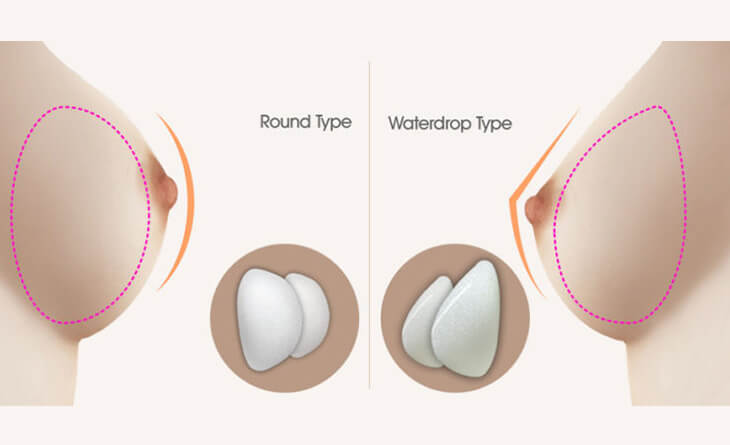 Breast implant