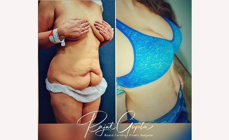 Breast implant before and after