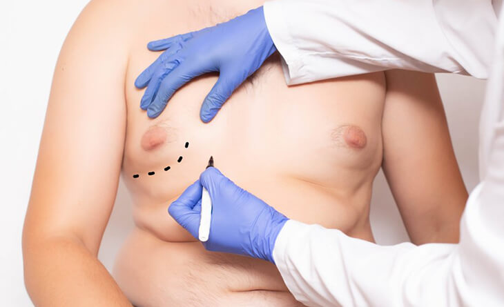 Gynecomastia surgery