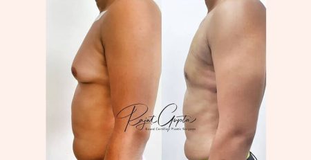 Gynecomastia surgery before and after