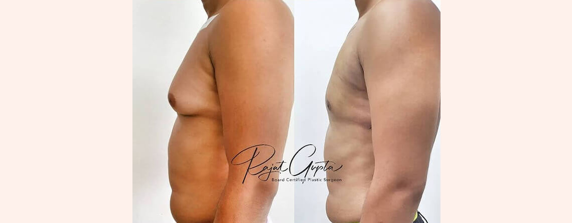 Gynecomastia surgery before and after