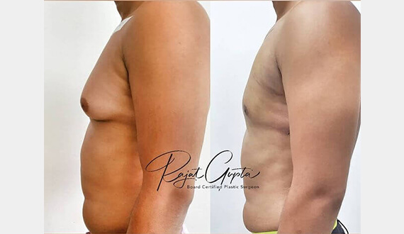 Scar-Free Gynecomastia Surgery in Delhi - Dr Rajat Gupta