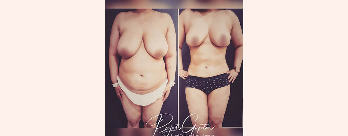 Liposuction surgery before and after