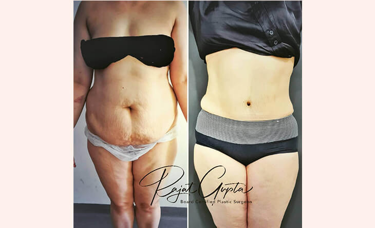 Tummy tuck surgery before and after