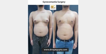 gynecomastia surgery before and after