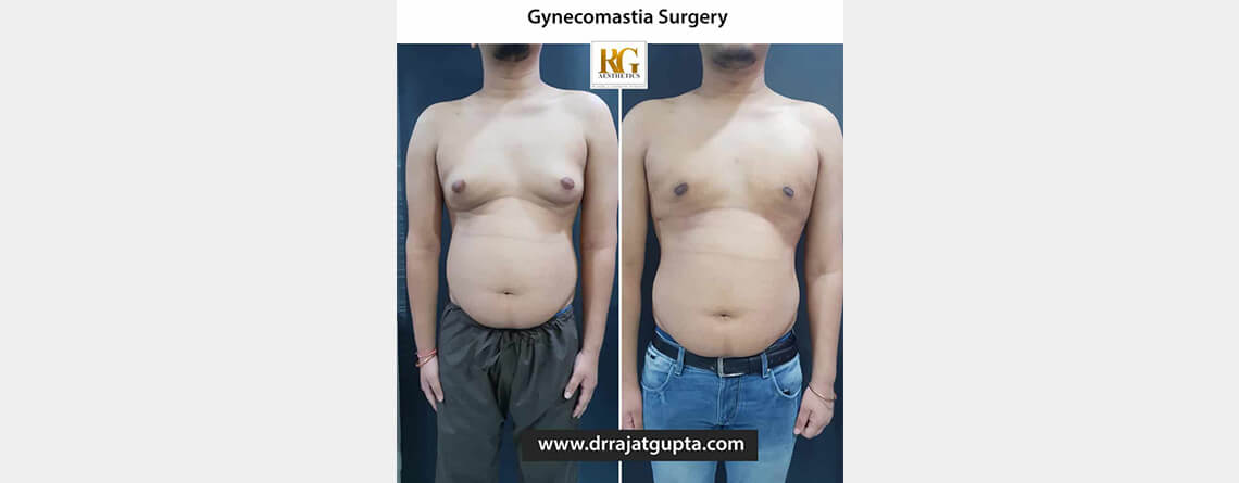 gynecomastia surgery before and after