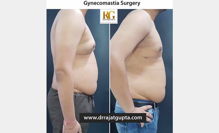 scarless gynecomastia surgery Delhi
