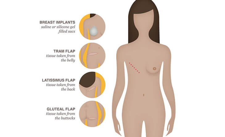 Breast Reconstruction Surgery