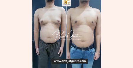 Dr Rajat Gupta gynecomastia Delhi